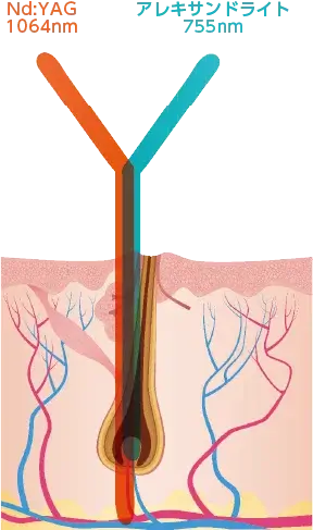 hair_removal3