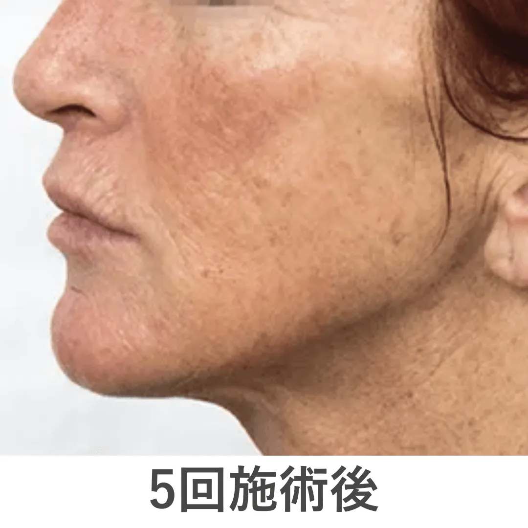 peeling_case1_after