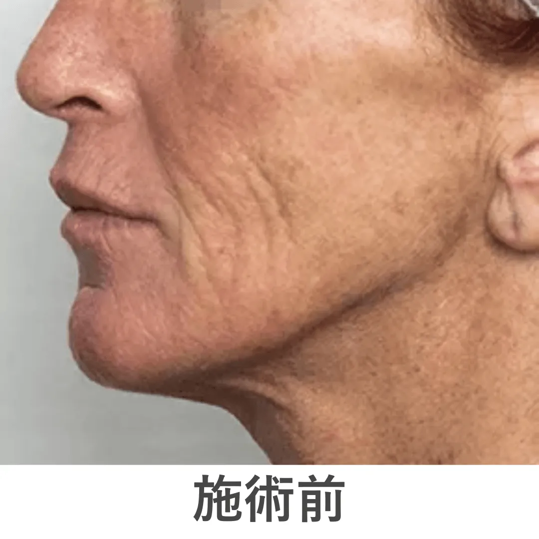 peeling_case1_before