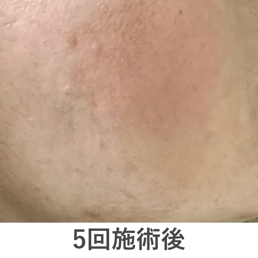 peeling_case2_after