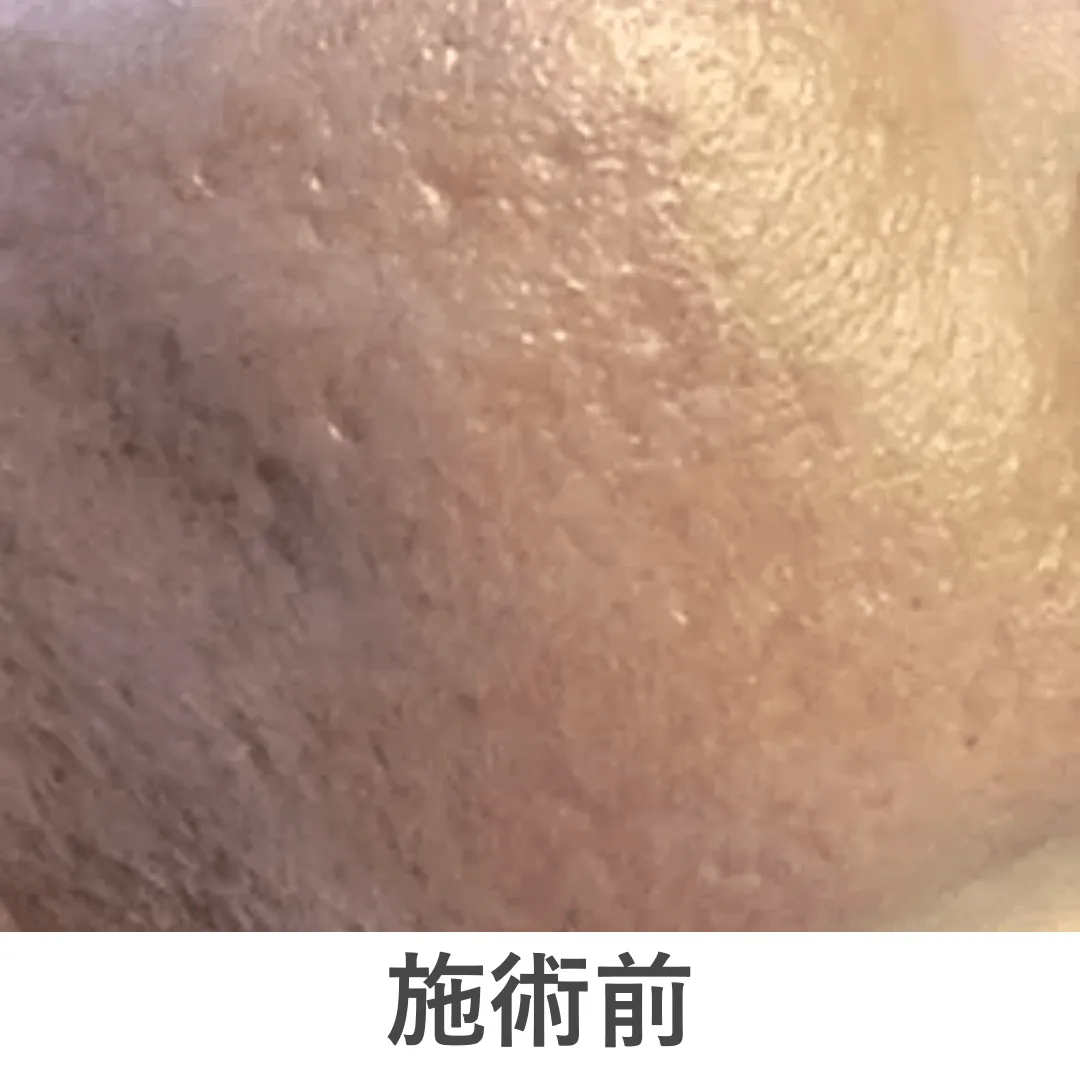 peeling_case2_before