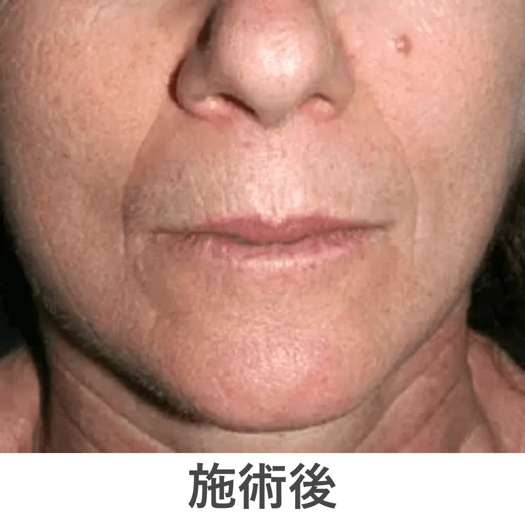 peeling_case3_after