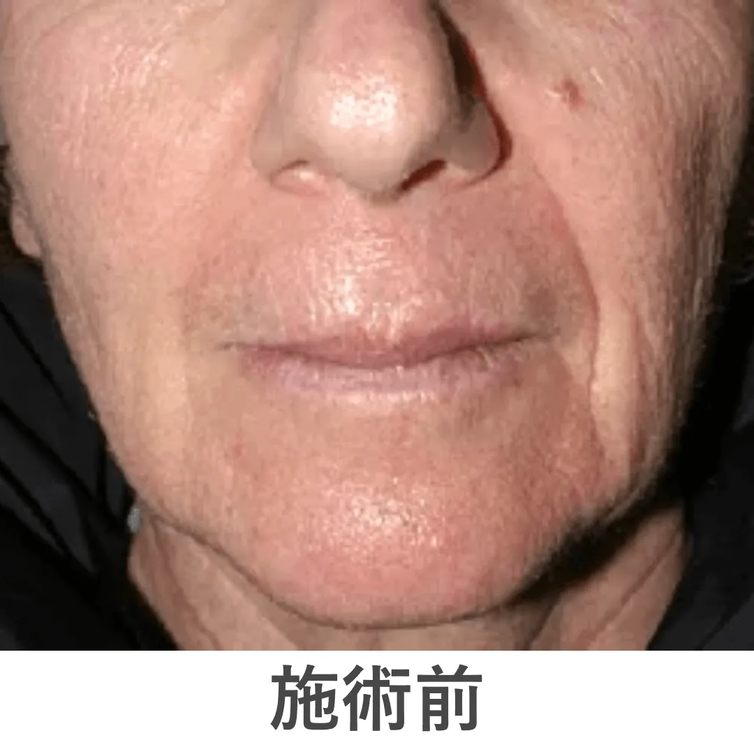 peeling_case3_before