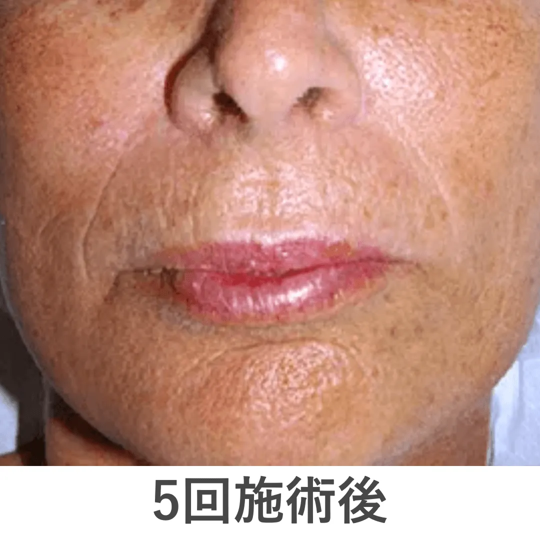 peeling_case4_after
