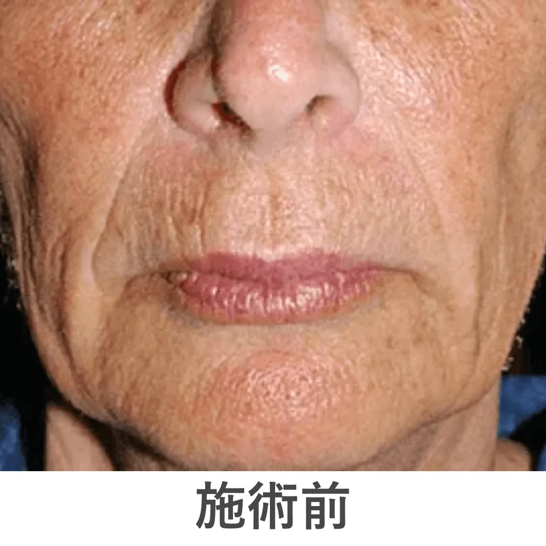 peeling_case4_before